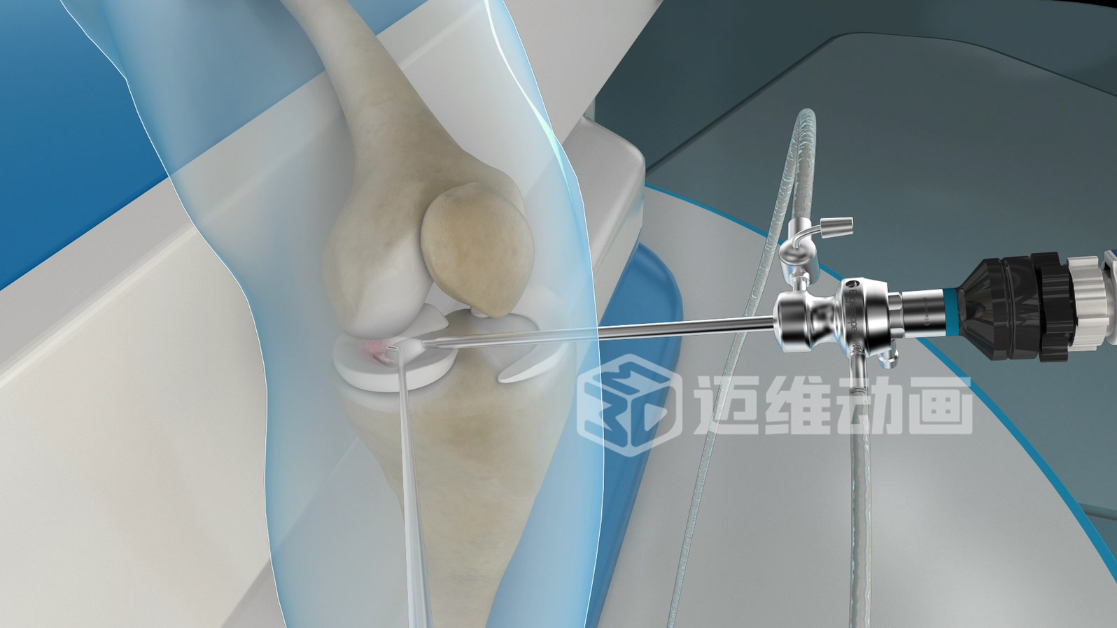 關(guān)節鏡手術(shù)三維動(dòng)畫(huà) 關(guān)節鏡手術(shù)三維動(dòng)畫(huà)